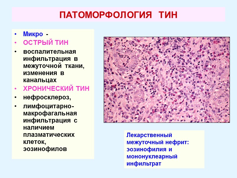 ПАТОМОРФОЛОГИЯ  ТИН  Микро -   ОСТРЫЙ ТИН воспалительная  инфильтрация в